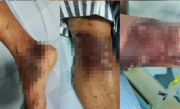 拆解不明金属物引发爆炸，佛山废品站一男子全身被炸伤