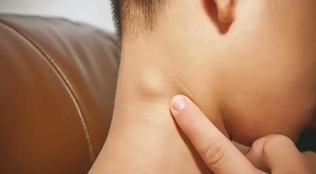 5岁男孩确诊癌症晚期!别忽视身上这种“小疙瘩”,很多人都有! 5岁男孩确诊癌症晚期!别忽视身上这种“小疙瘩”,很多人都有!