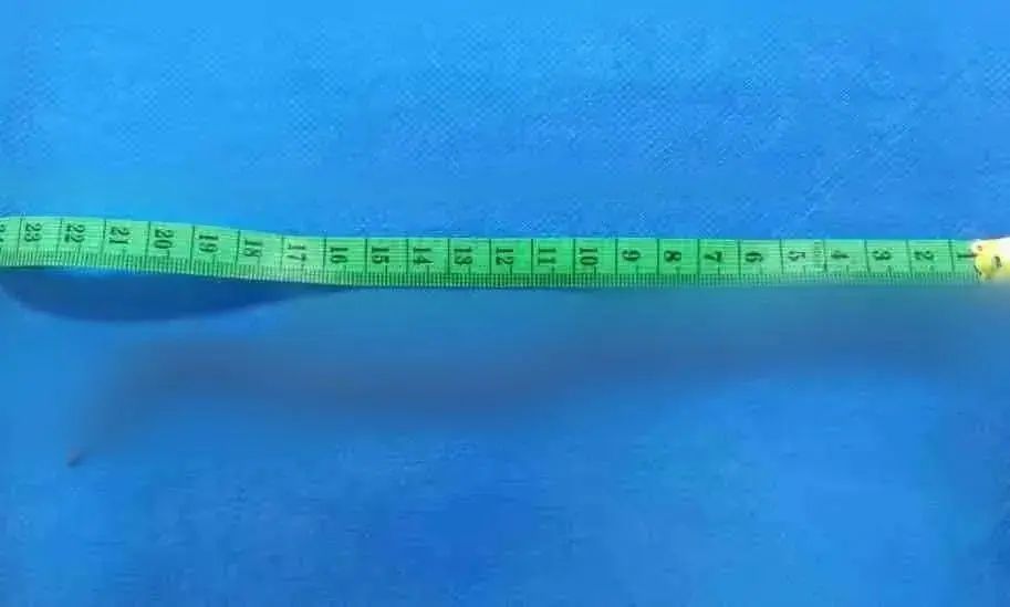 冲上热搜！女子体内取出20厘米活虫，只因频繁吃这种东西......