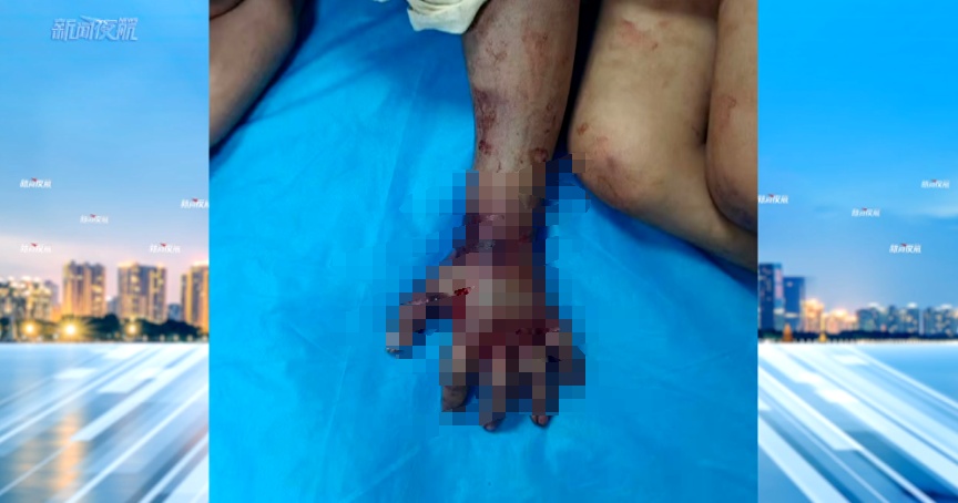 6岁男孩被毒蛇咬伤！紧急送哈尔滨......