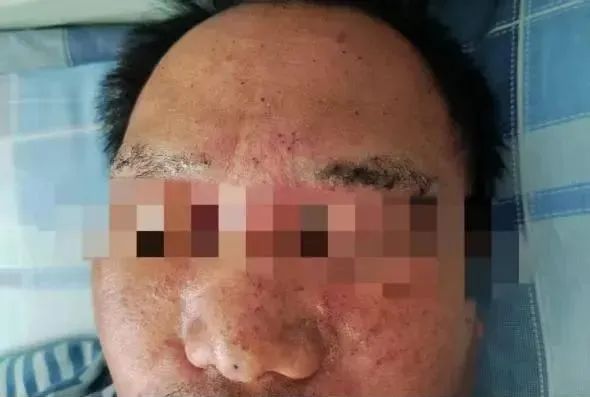 拆解不明金属物引发爆炸，佛山废品站一男子全身被炸伤