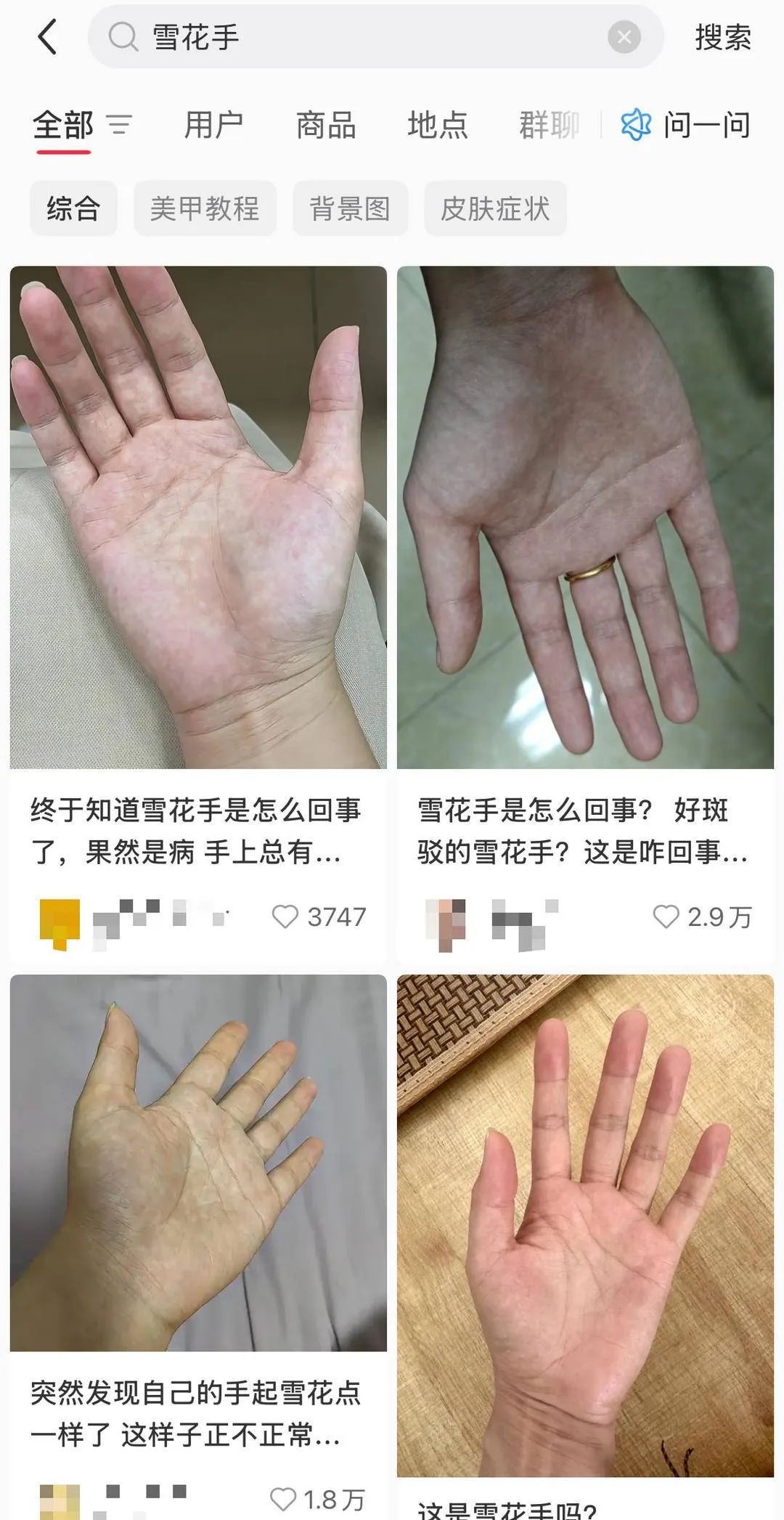 手掌惊现“雪花”？别慌，多数是生理现象