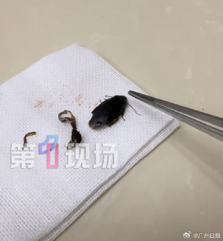 女子耳朵遭黑虫钻入塞满整个耳道！ 医生建议：掏耳朵无需太干净，耳屎防尘也防虫钻