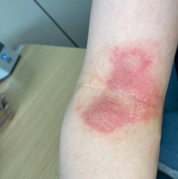 夜游归来男子手臂突然红肿糜烂,近期多人中招!医生紧急提醒 夜游归来男子手臂突然红肿糜烂,近期多人中招!医生紧急提醒