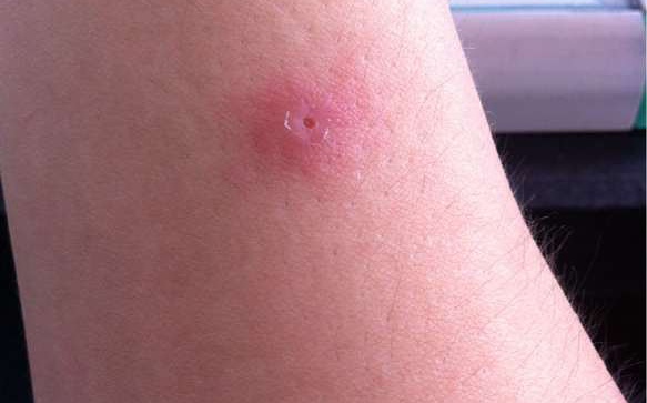 杭州深夜，他们集体被“袭击”！紧急送医……确认是马蜂蜇伤