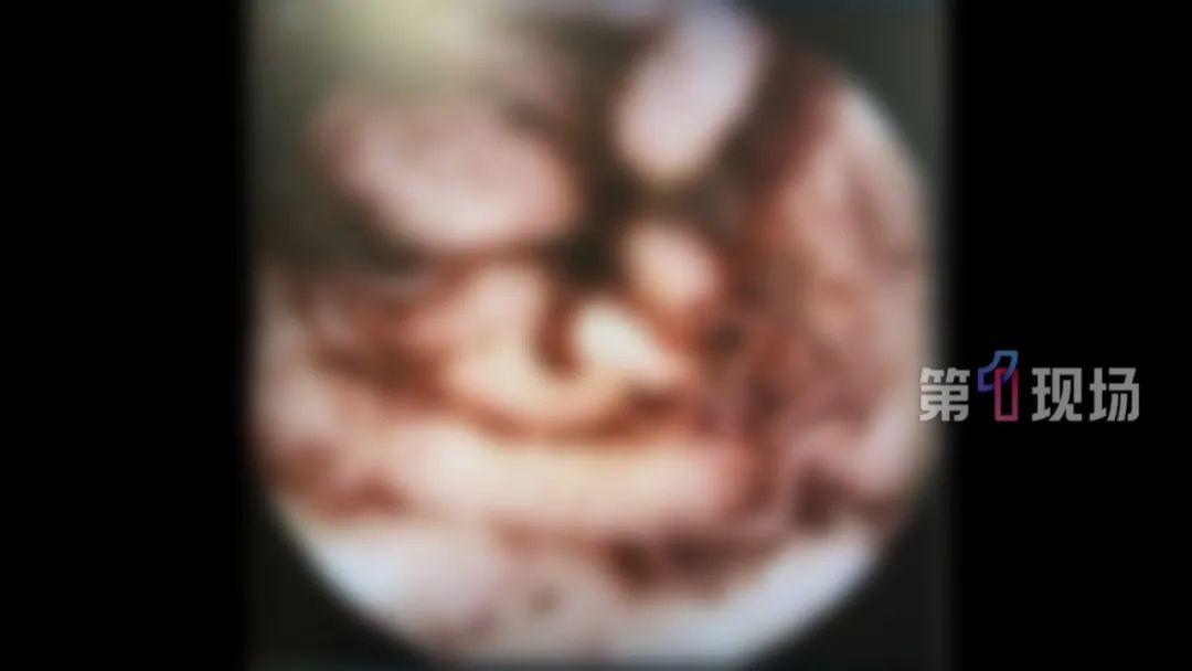 明星同款“彩椒碗”爆火，女子吃出“肠道吸血鬼”，只因…