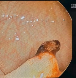 男童肛门大出血、濒临休克，竟是因为家长一个小动作？