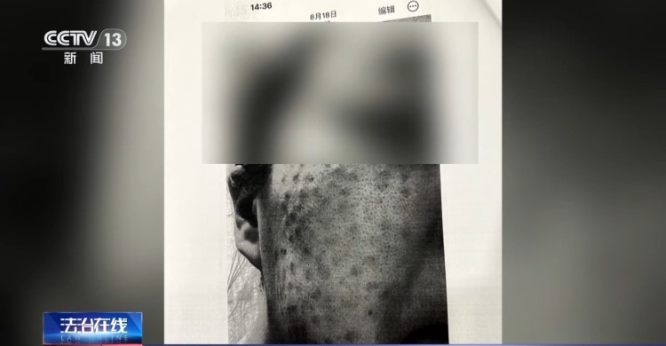 打美容针竟致十级伤残！在医生家中做医美 出了事谁负责？