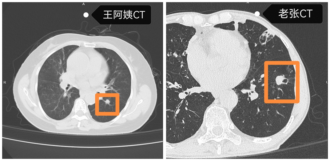 浙江夫妻俩先后查出同一种癌症!问题很可能出在老公的这个习惯上... 浙江夫妻俩先后查出同一种癌症!问题很可能出在老公的这个习惯上...