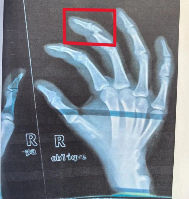 5个月内两次“撞伤”同一个人，这么巧？