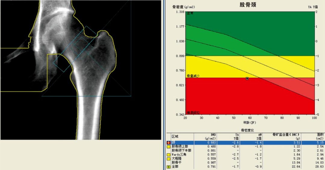 坚持补钙12年，仍骨质疏松？医生：忽略这些习惯，吃再多钙片也浪费