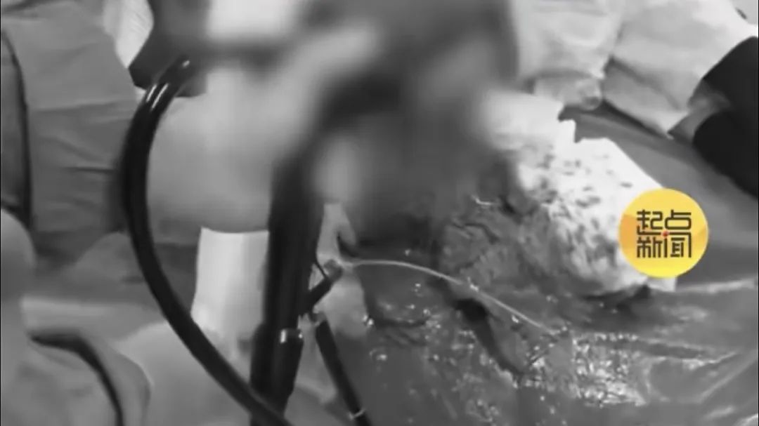 男子腹中堆积40斤粪便!医生手术"泄"货,瞬间喷涌而出… 男子腹中堆积40斤粪便!医生手术"泄"货,瞬间喷涌而出…