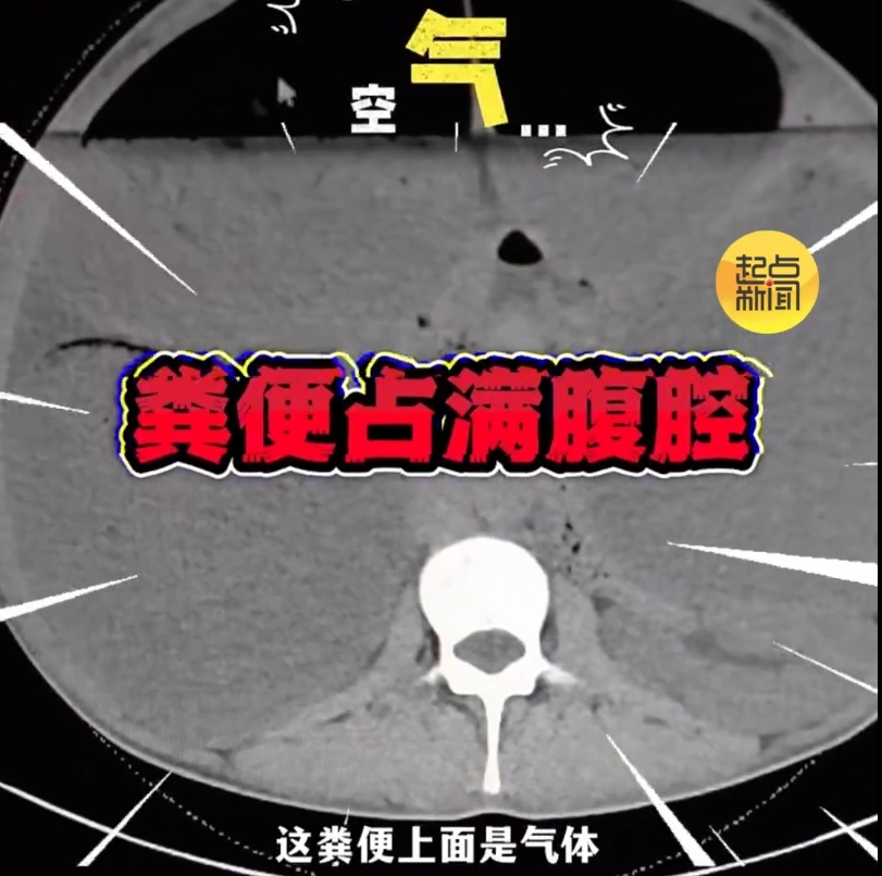男子腹中堆积40斤粪便!医生手术"泄"货,瞬间喷涌而出… 男子腹中堆积40斤粪便!医生手术"泄"货,瞬间喷涌而出…