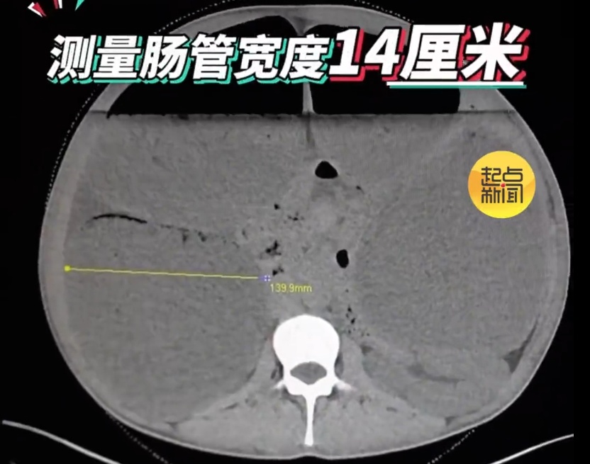 男子腹中堆积40斤粪便!医生手术"泄"货,瞬间喷涌而出… 男子腹中堆积40斤粪便!医生手术"泄"货,瞬间喷涌而出…