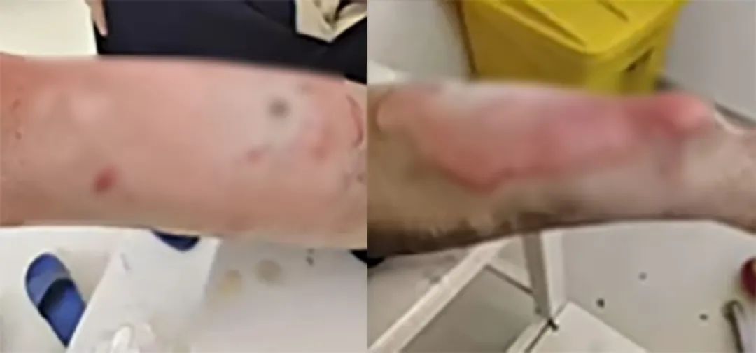 充电宝在口袋里自燃，小伙大腿三度烧伤！