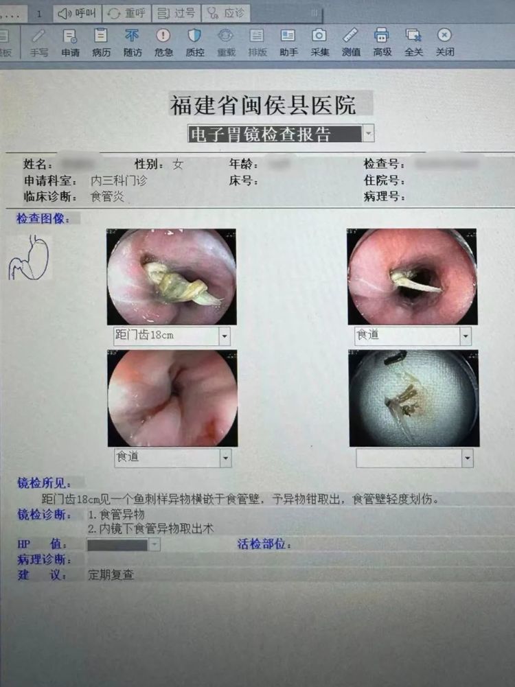 就因一根鱼刺，福州陈女士差点没命！