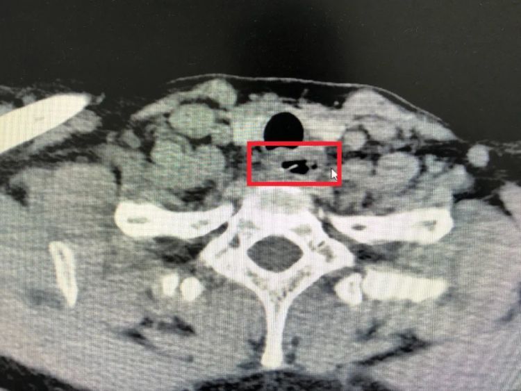 就因一根鱼刺，福州陈女士差点没命！