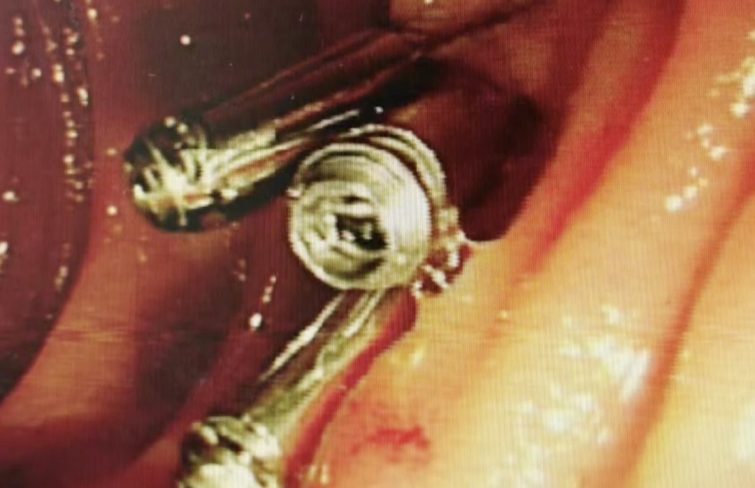 一个动作，男子喝水不慎连它喝进肚，刺穿肠壁直击右肾！