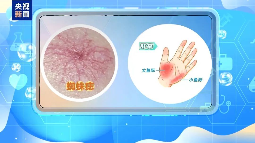 皮肤上出现这种“信号”，可能是肝出问题了！