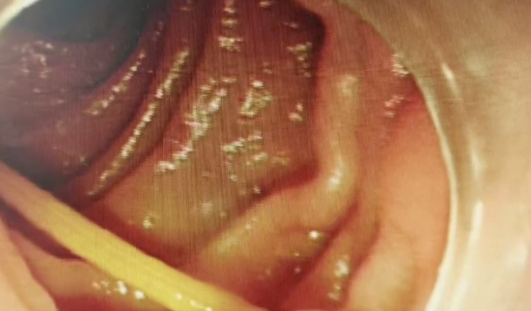 一个动作，男子喝水不慎连它喝进肚，刺穿肠壁直击右肾！