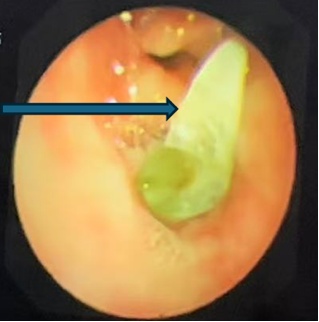 6岁娃咳血送医，肺里挖出半年前的糖果包装袋！医生：这种呛咳别大意