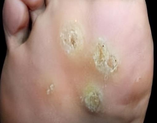 长了这几种小疙瘩,别大意!可能和 HPV 有关 长了这几种小疙瘩,别大意!可能和 HPV 有关