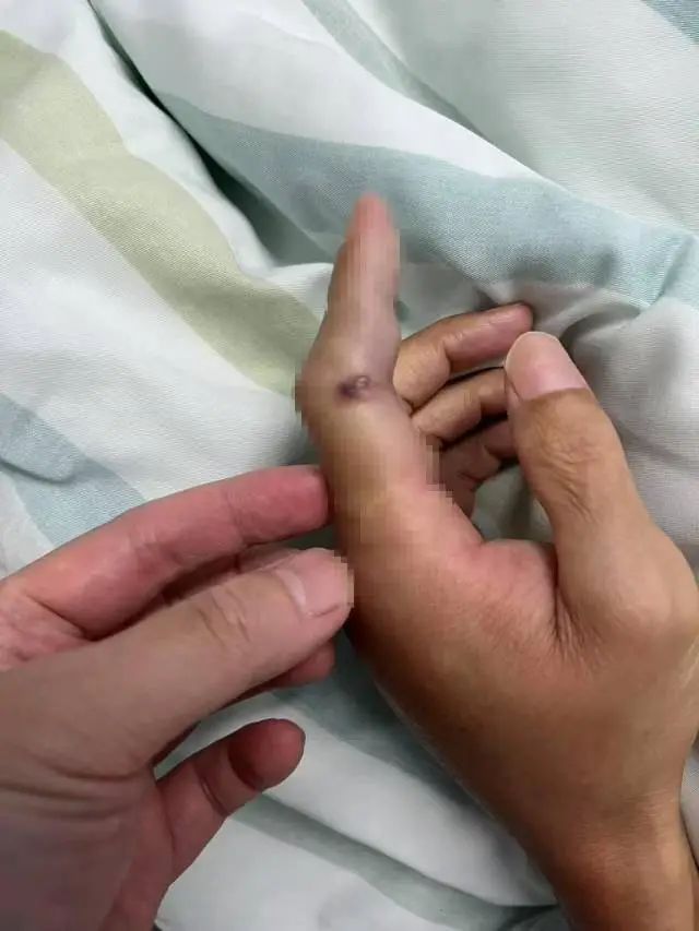 戴手套!男子中招被送进ICU 致死率或达100% 戴手套!男子中招被送进ICU 致死率或达100%