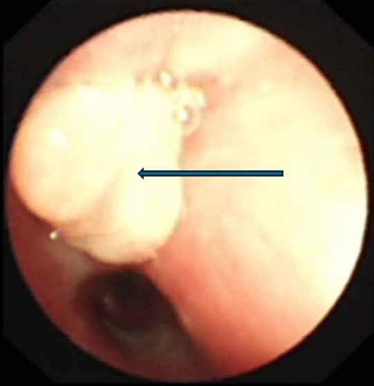 6岁娃咳血送医，肺里挖出半年前的糖果包装袋！医生：这种呛咳别大意