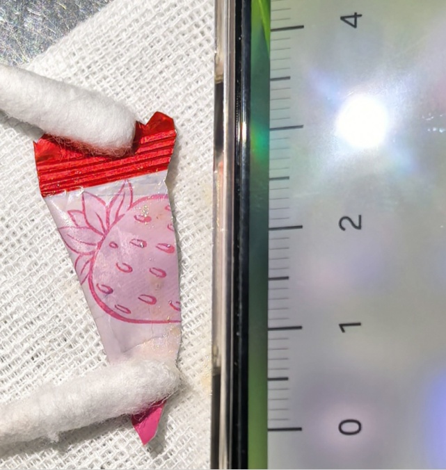 6岁娃咳血送医，肺里挖出半年前的糖果包装袋！医生：这种呛咳别大意