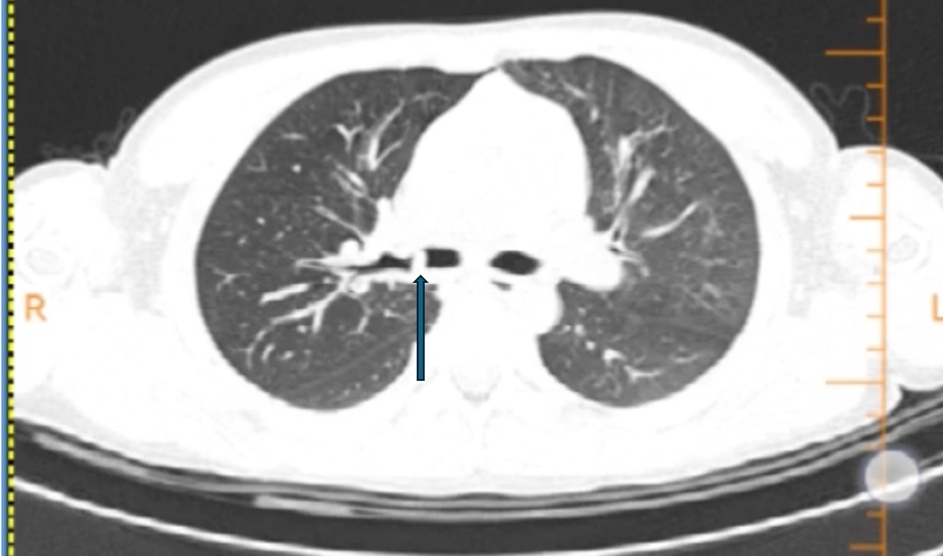6岁娃咳血送医，肺里挖出半年前的糖果包装袋！医生：这种呛咳别大意