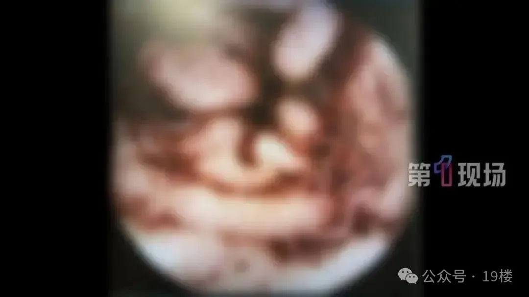 女子肚中出现“肠道吸血鬼”！只因吃了明星同款“减脂餐”……医生紧急提醒