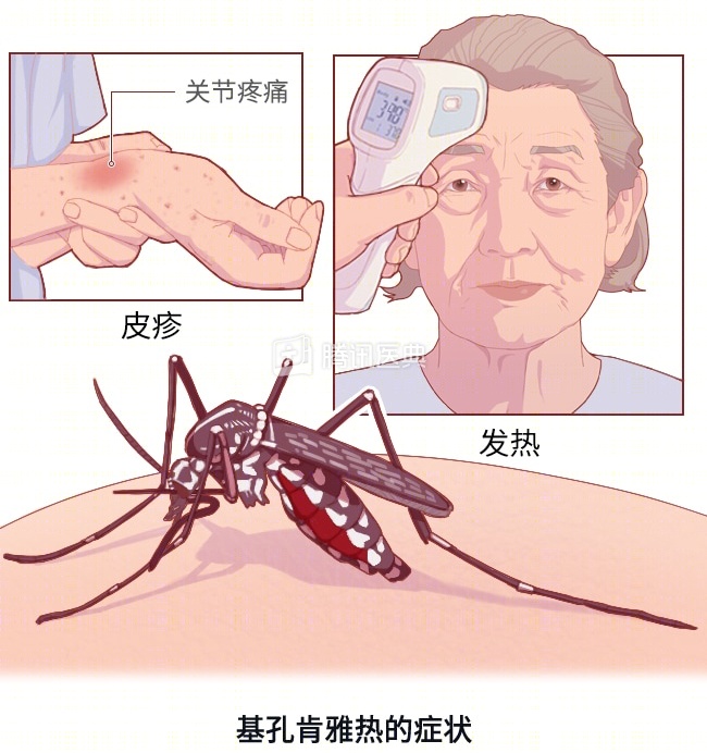 关节剧痛+全身起疹子！警惕这个夏天最毒的“热”