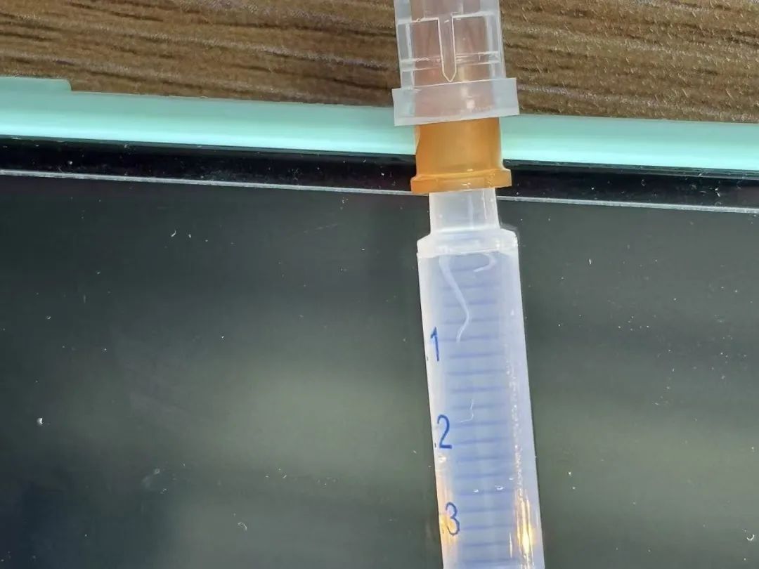 杭州女子眼睛长出6条虫！医生：非常少见