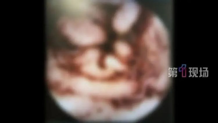 明星同款“彩椒碗”爆火！女子跟风吃出“肠道吸血鬼”？医生紧急提醒……