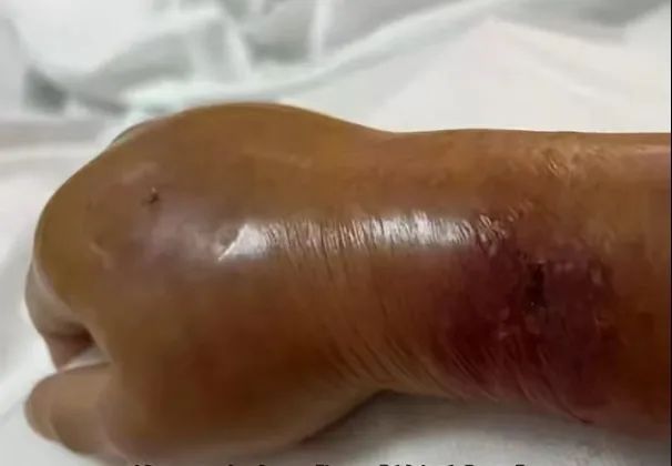 被鱼刺扎伤手指竟住进ICU！警惕这个致命细菌