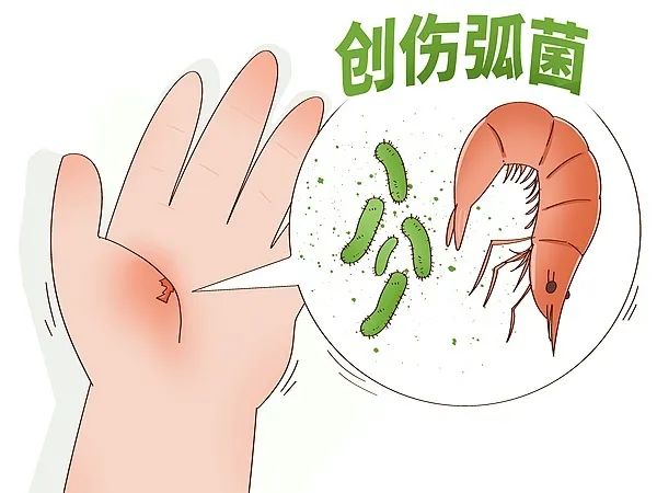 被鱼刺扎伤手指竟住进ICU！警惕这个致命细菌