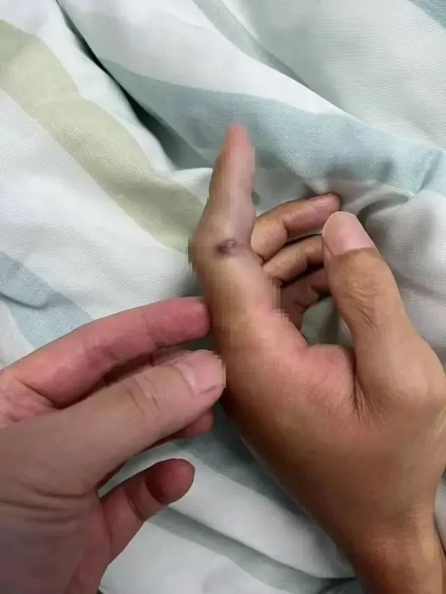 被鱼刺扎伤手指竟住进ICU！警惕这个致命细菌