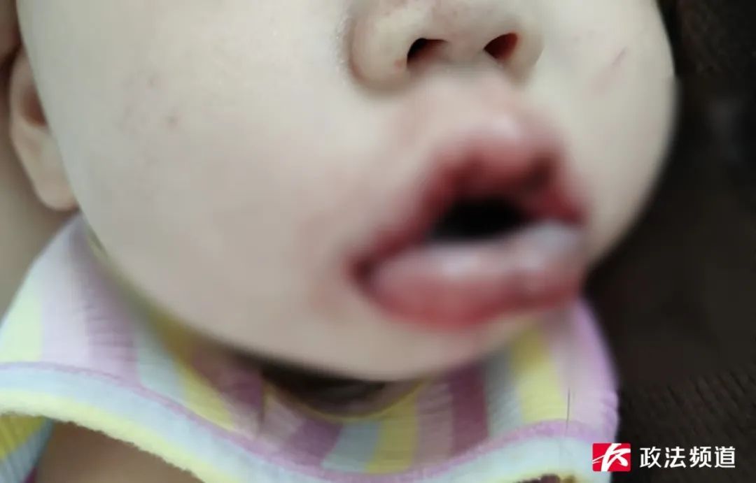 1岁半女童把它放进嘴巴，住进ICU！不少人家里都有
