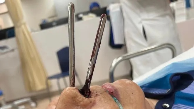 92岁老人摔倒"筷子从鼻孔插到脑"!医院：家属这举动能保命