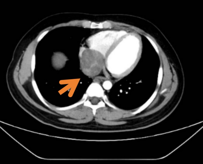 确诊恶性癌!杭州00后小伙傻眼:不抽烟不熬夜,平时一点感觉都没...... 确诊恶性癌!杭州00后小伙傻眼:不抽烟不熬夜,平时一点感觉都没......