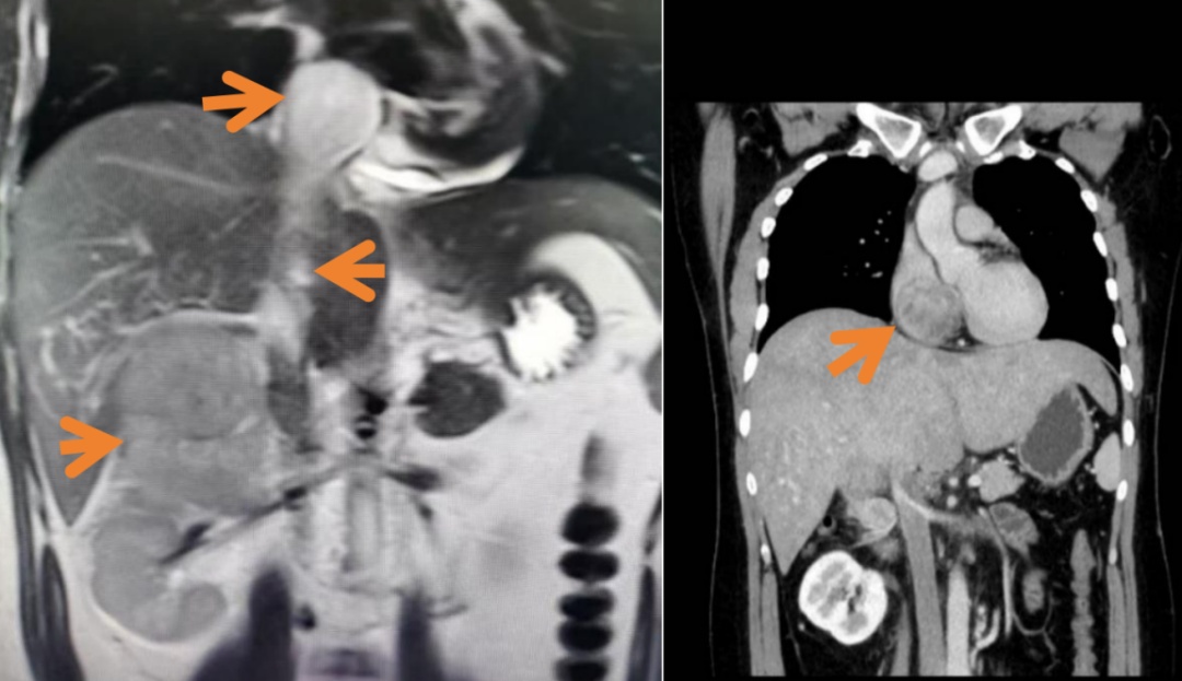 确诊恶性癌!杭州00后小伙傻眼:不抽烟不熬夜,平时一点感觉都没...... 确诊恶性癌!杭州00后小伙傻眼:不抽烟不熬夜,平时一点感觉都没......