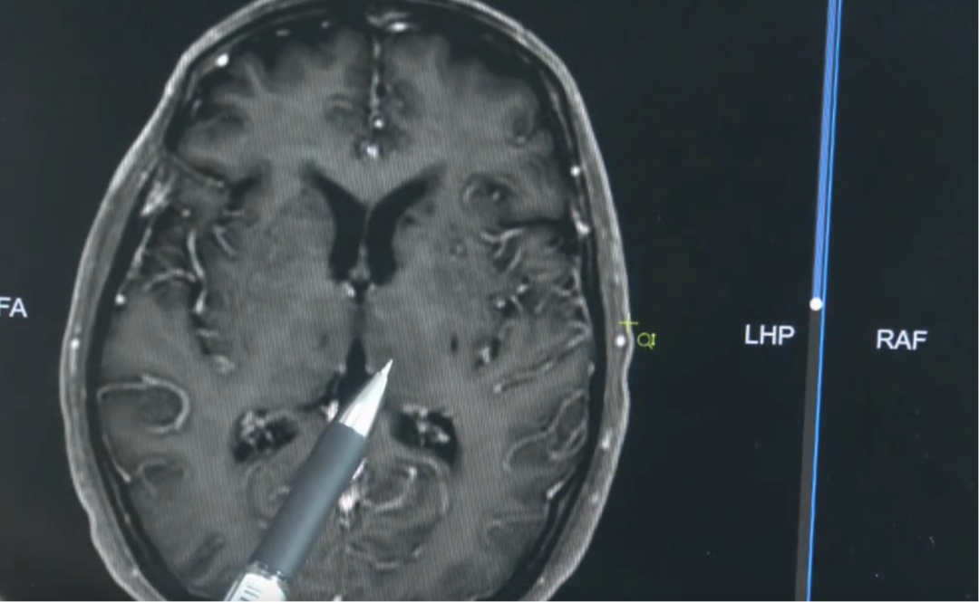 男子接触生猪肉后突然双耳全聋！医生紧急提醒