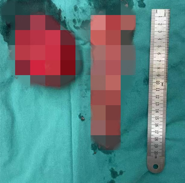 确诊恶性癌!杭州00后小伙傻眼:不抽烟不熬夜,平时一点感觉都没...... 确诊恶性癌!杭州00后小伙傻眼:不抽烟不熬夜,平时一点感觉都没......