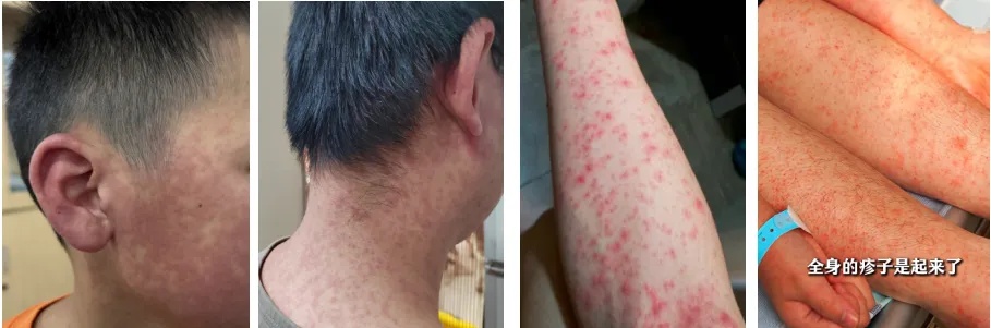 佛山市三水区发布基孔肯雅热后遗症告知书