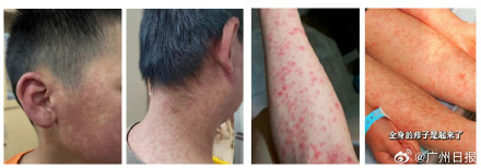 佛山一地发布基孔肯雅热后遗症告知书