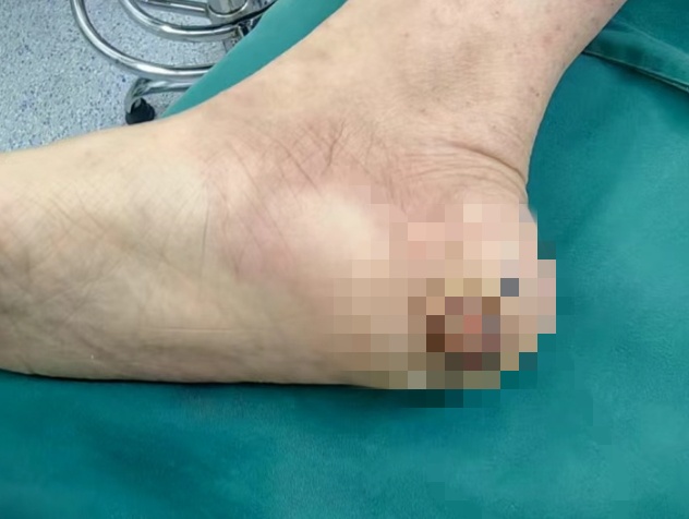浙江女子脚被扎伤后，长出的小肉球竟是 “癌中之王”！医生：警惕这种伤口