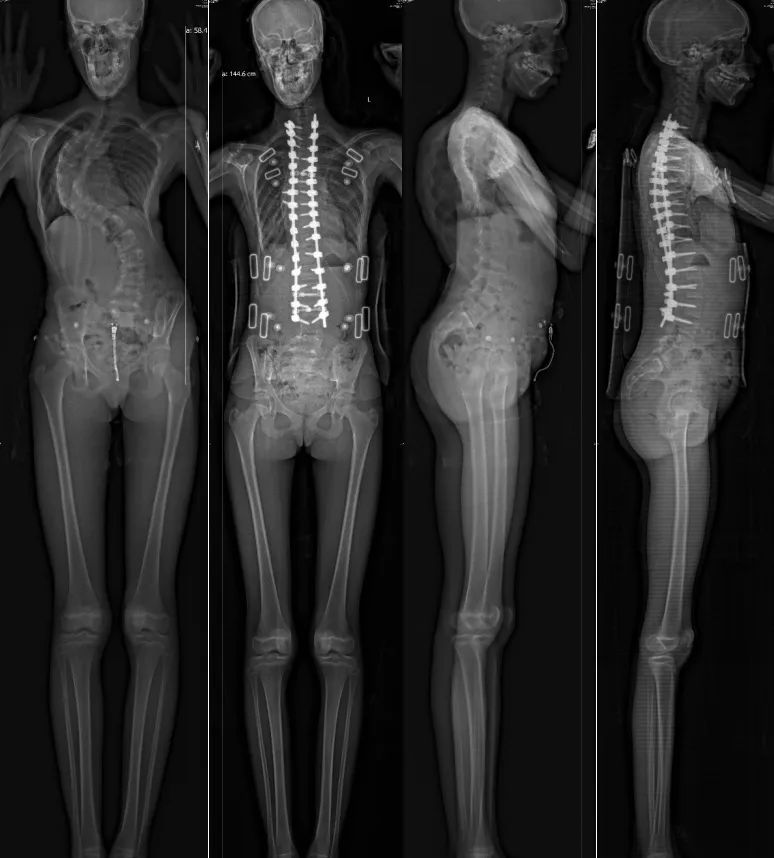 脊柱侧弯角度104度！12岁英国少女跨越千里来上海求治，术后一下“长高”8厘米