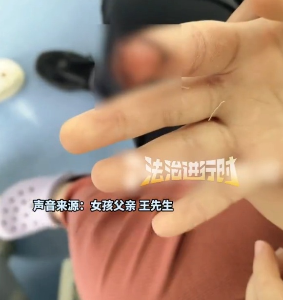 北京7岁女童喂马时被咬伤手指指甲断裂，度假区致歉：先行支付10万元