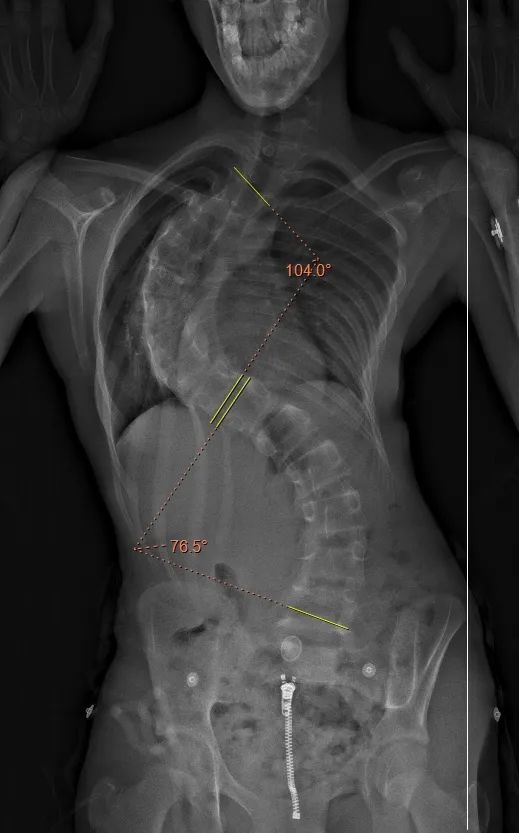 脊柱侧弯角度104度！12岁英国少女跨越千里来上海求治，术后一下“长高”8厘米