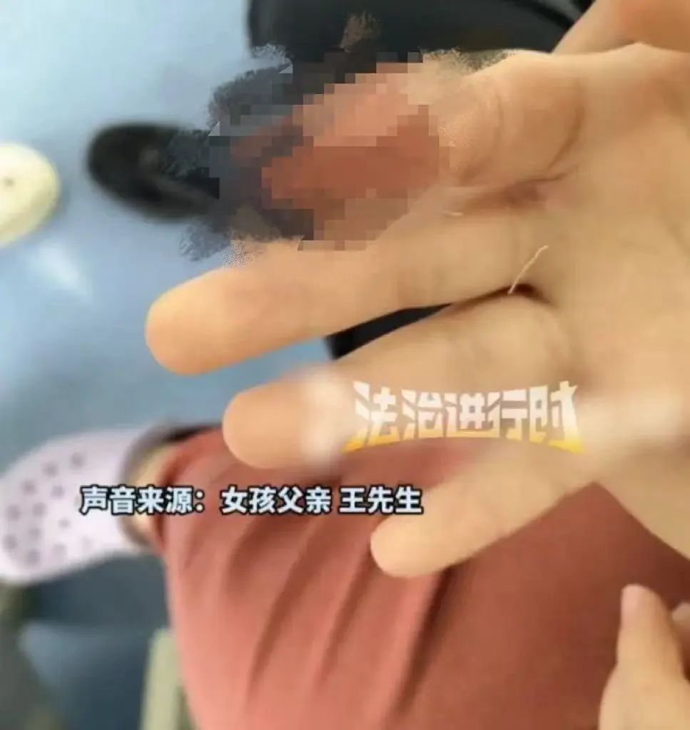 7岁女童被汗血宝马咬伤手指前端，景区回应：先行支付10万元赔偿款